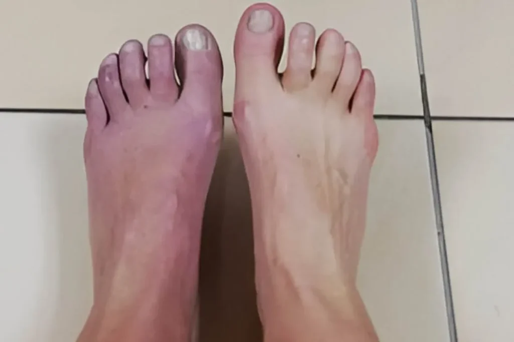 Algodystrophie phase froide : traitements efficaces à connaître