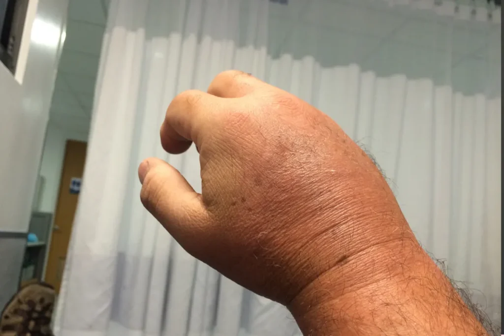 Algodystrophie phase froide